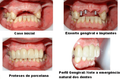 Foto De Implante Dentário E Enxerto Gengival Antes E Depois